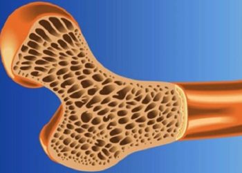 پوکی استخوان در نیمی از جمعیت کشور، وضعیت دستگاه‌های سنجش تراکم استخوان